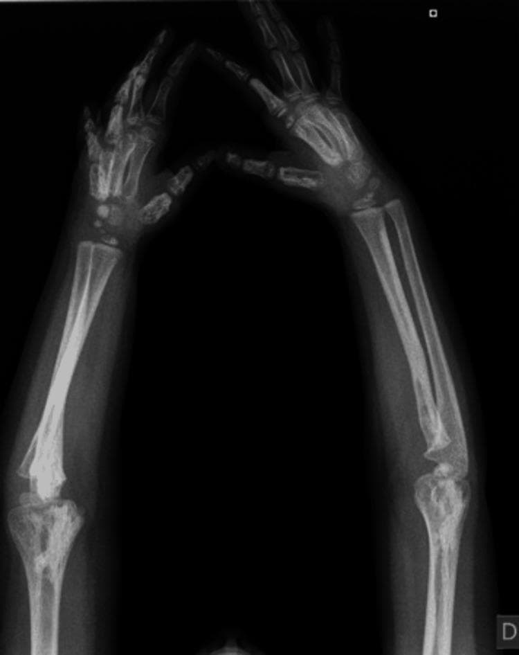 This diagnostic image is a plain radiograph (X-ray) of the bilateral forearms, wrists, and hands of a pediatric patient, demonstrated by the presence of open growth plates. The imaging reveals significant cortical hyperostosis and sclerosis affecting the diaphyses and metaphyses of the radius and ulna bilaterally. There is a marked increase in bone density (radiopacity) and thickening of the cortical layer, resulting in an irregular, undulating surface morphology. In the hands, diffuse hyperdensities are observed within the carpal bones, metacarpals, and phalanges, which appear abnormally sclerotic and irregularly shaped. The radiographic appearance is characteristic of a sclerosing bone dysplasia, such as melorheostosis or Camurati-Engelmann disease, where excessive bone formation alters normal skeletal architecture. These findings are clinically relevant for evaluating causes of limb stiffness, joint contractures, and skeletal deformities in pediatric orthopedics and radiology.