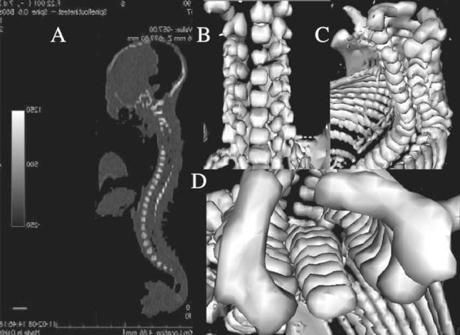 This diagnostic image composite features CT scans and three-dimensional (3D) reconstructions of a 25-week-old human fetus, focusing on skeletal development and ossification centers. Panel A displays a sagittal DICOM image illustrating the fetal profile, skull, and the full longitudinal curvature of the vertebral column with varying radiopacity. Panels B, C, and D provide high-resolution 3D reconstructions in frontal, lateral, and horizontal planes, respectively. These views highlight the vertebral bodies and the distinct ossification centers of the neural processes. The frontal view (B) shows the stacked alignment of the vertebrae and ribs. The lateral view (C) demonstrates the relationship between the posterior elements and the rib cage. The horizontal cross-section (D) emphasizes the morphology of the C4 vertebral body, showcasing its transverse and sagittal dimensions during late second-trimester development. This set of images is used to assess fetal growth dynamics, specifically the morphometric parameters of vertebral ossification in prenatal anatomy.