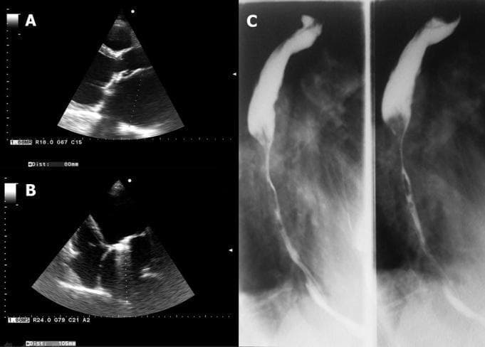 This composite diagnostic image includes echocardiography and barium contrast radiography to demonstrate cardiovascular and gastrointestinal pathology. Panel A shows a transthoracic echocardiogram in the parasternal long axis view, documenting severe left atrial enlargement with a postero-anterior diameter measurement of 80mm. Panel B displays an apical four-chamber view, revealing a significantly dilated left atrium with a longitudinal diameter measured at 105mm. Panel C presents two vertical X-ray views from a barium swallow (upper gastrointestinal series). These radiographs show the esophagus with contrast, highlighting significant luminal narrowing (stricture) in the middle and lower esophageal segments, contrasted against proximal dilation. The clinical correlation suggests an extrinsic compression of the esophagus, likely due to the massive left atrial enlargement (cor bovinum) observed in the echocardiography, a phenomenon known as Ortner's syndrome or dysphagia megalatriensis.