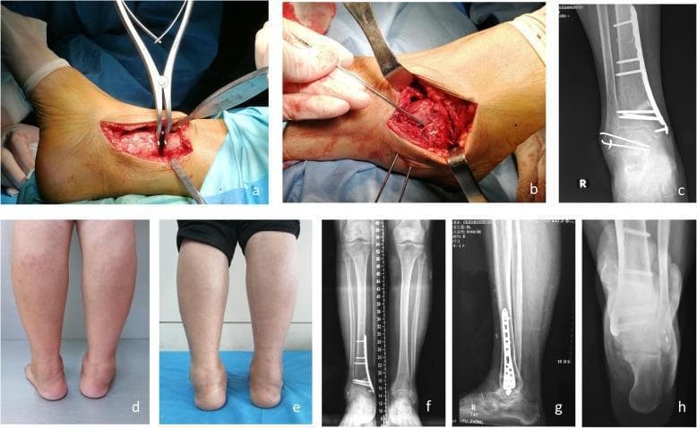 This composite figure illustrates the surgical management and longitudinal follow-up of a patient with varus ankle arthritis. Panels (a) and (b) are intraoperative clinical photographs showing anteromedial and anterolateral surgical approaches for supramalleolar osteotomy and lateral ligament reconstruction. Panel (c) is a 6-week postoperative anteroposterior (AP) radiograph showing Kirschner wire (K-wire) fixation of the talus. Panels (d) and (e) are clinical photographs comparing preoperative and 20-month postoperative hindfoot alignment, demonstrating correction from a varus deformity to a neutral axis. Panels (f), (g), and (h) provide 20-month postoperative weight-bearing imaging, including AP, lateral, and hindfoot alignment radiographs. These diagnostic images reveal a medial distal tibial locking plate and screws fixating the supramalleolar osteotomy site. Key educational concepts shown include the surgical correction of distal tibial alignment, the use of K-wires for temporary talar stabilization, and the objective improvement of joint matching and tibial-talar angles (MDTA, ADTA, TTA) in the context of late-stage ankle arthritis.