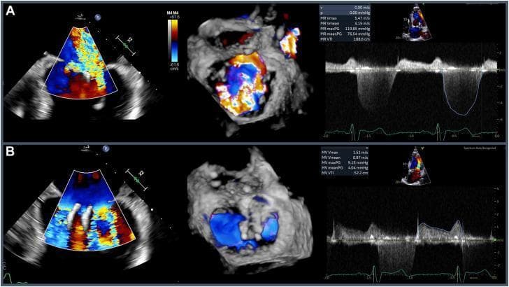 Multi-panel pre-procedure echocardiographic assessment of mixed mitral valve disease. Panel A displays a transesophageal echocardiogram (TEE) bicommissural view (60 degrees) with color Doppler and 3D reconstruction, revealing severe mitral regurgitation. The imaging shows eccentric lateral and medial regurgitant jets with mosaic turbulent flow. Corresponding pulse wave Doppler demonstrates holosystolic flow with a high maximum velocity (Vmax) of 5.47 m/s. Panel B utilizes the same TEE views to evaluate mitral stenosis. Color Doppler and 3D imaging show turbulent flow across the valve orifice. Pulse wave Doppler quantification indicates a peak gradient of 9 mmHg and a mean gradient of 4 mmHg, consistent with moderate mitral stenosis. This composite image serves as a clinical diagnostic tool for evaluating structural valvular disease, specifically assessing regurgitant jet morphology, flow velocity, and pressure gradients across the mitral valve in a patient with prior MitraClip interventions.