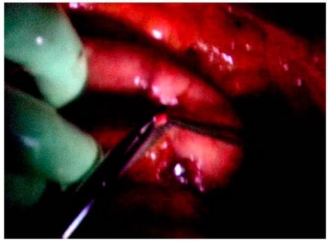 This intraoperative clinical photograph demonstrates 5-aminolevulinic acid (ALA)-guided photodynamic diagnosis (PDD) during cytoreductive surgery for peritoneal malignancy. The image shows a dark reddish surgical site, likely the peritoneal surface, containing multiple small, whitish, translucent residual nodules. Under violet light excitation (405 nm), one specific nodule exhibits prominent red fluorescence, indicative of tumor-specific protoporphyrin IX (PpIX) accumulation. A surgical grasping instrument held by a green-gloved hand is seen precisely targeting this fluorescing nodule for excision. This visual illustrates the clinical utility of PDD in identifying microscopic or residual disease that may be missed under standard white light after macroscopic complete resection. The technique leverages the heme synthesis pathway where cancer cells selectively accumulate PpIX, facilitating more thorough cytoreduction in surgical oncology.