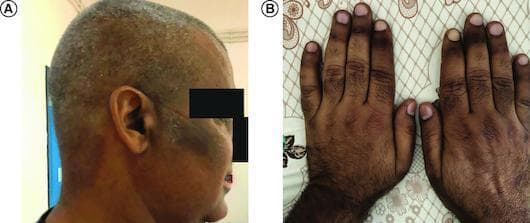 Clinical photograph in two panels (A and B) demonstrating cutaneous hyperpigmentation associated with vitamin B12 deficiency. Panel A shows a lateral view of the head and neck, highlighting patchy, irregular melanoderma on the temporal region and cheek, with a mottled distribution across the scalp. The pigmentation ranges from light tan to dark brown and appears non-elevated and non-scaly. Panel B displays the dorsal surfaces of both hands, revealing generalized darkening with accentuated intensity over the knuckles and phalangeal creases. A proximal-to-distal gradient is visible on the fingers, with the most intense hyperpigmentation occurring proximally. These findings are characteristic of the mucocutaneous manifestations of megaloblastic anemia and vitamin B12 deficiency, serving as a critical clinical sign for differential diagnosis from Addison’s disease.