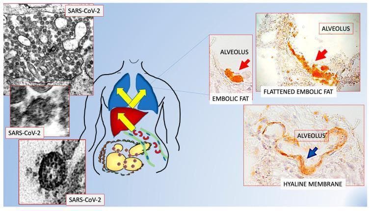 A multi-panel medical infographic and diagnostic montage illustrating the proposed pathophysiology of fat embolism in COVID-19. On the left, transmission electron microscopy (TEM) images show spherical SARS-CoV-2 virions with characteristic surface spike projections and dense internal nucleocapsids. A central anatomical diagram depicts the pathway of inflammatory factors and fat moving from visceral adipose tissue (labeled with hyperinflammation) through the venous system to the heart and lungs. On the right, histopathological images show alveolar structures. Two panels demonstrate pulmonary fat embolism with brightly stained orange/red fat globules and flattened embolic masses within the alveolar spaces. A third panel displays an alveolus with a distinct hyaline membrane, characterized by a smooth, translucent lining along the alveolar wall, typical of diffuse alveolar damage. This composite visualizes the clinical link between visceral obesity, viral infection, and sudden bilateral pneumonia.