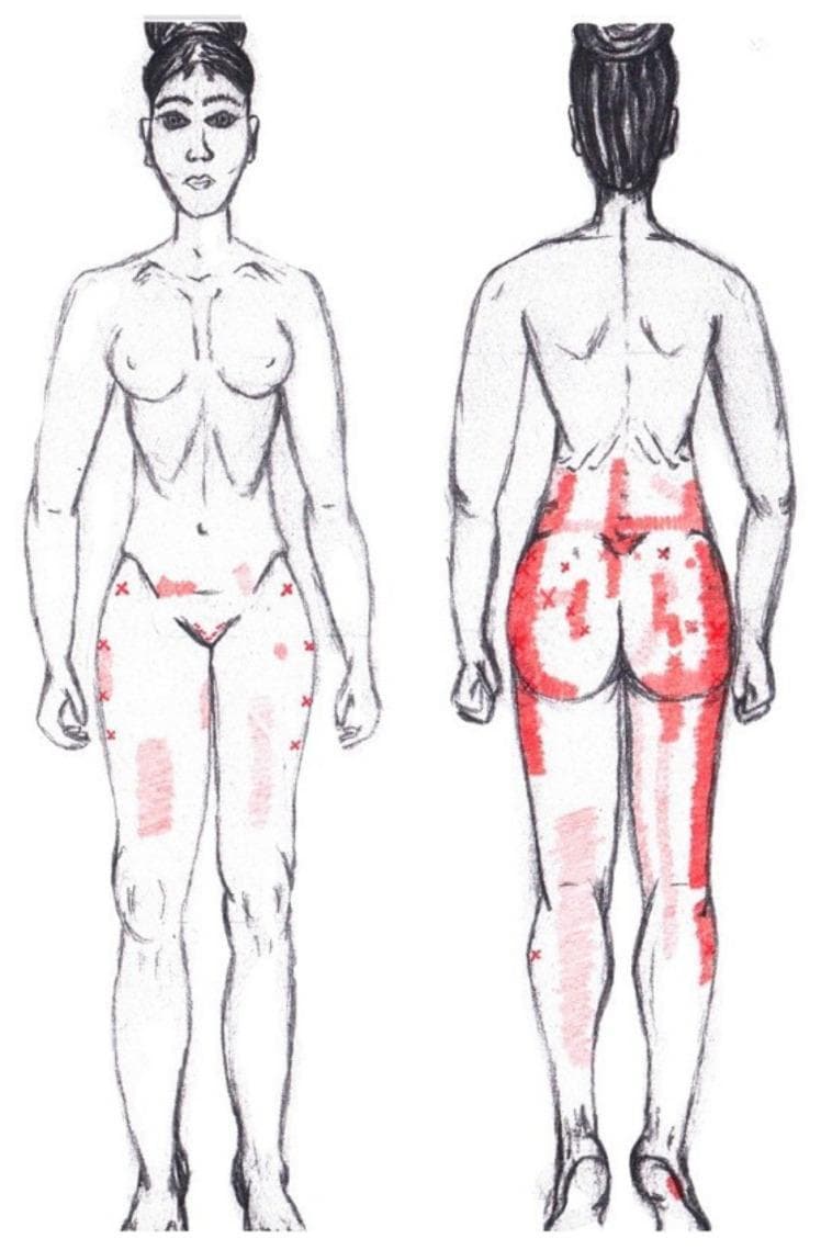This medical illustration is a graphical simulation depicting the referred pain pattern associated with myofascial trigger points in the gluteus minimus muscle. The diagram includes anterior and posterior views of a female figure with red-shaded regions indicating pain distribution. On the posterior view, the pain is most concentrated in the gluteal region, particularly over the buttock, and radiates superiorly into the lumbar region and inferiorly along the posterior aspect of the thigh and calf. The right side shows more extensive distal radiation down to the ankle compared to the left. On the anterior view, referred pain is illustrated in the lower abdominal/inguinal region, the lateral hip (greater trochanter area), and extending down the anterior and lateral aspects of the thigh towards the knee. Small 'x' marks within the shaded areas signify the location of active trigger points. This diagram serves as an educational tool for identifying referred pain pathways in musculoskeletal medicine and physical therapy, specifically for differentiating gluteus minimus involvement from other lumbosacral or hip pathologies.