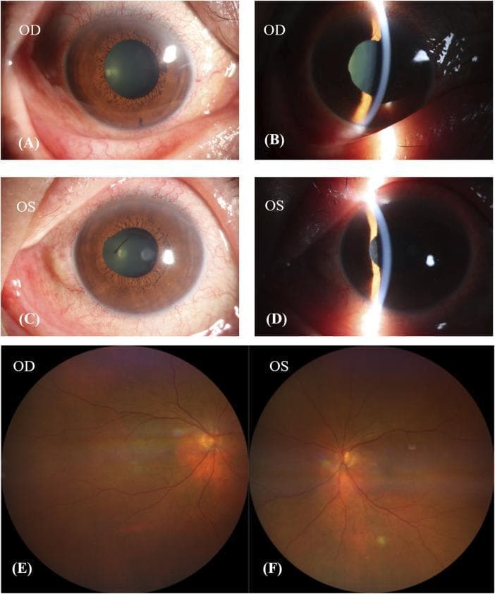 This composite of clinical ophthalmic images displays both anterior segment photographs and fundus images of the right (OD) and left (OS) eyes, illustrating manifestations of Vogt-Koyanagi-Harada (VKH)-like disease. Panels A through D represent anterior segment views: Slit-lamp biomicroscopy reveals ciliary hyperemia, conjunctival injection, and irregular pupillary margins indicative of posterior synechiae (adhesions between the iris and lens). These findings are consistent with active or chronic anterior uveitis. Panels E and F provide fundus photography showing a classic 'sunset-glow fundus' appearance. This is characterized by diffuse choroidal depigmentation, resulting in a prominent reddish-orange hue across the retina. The optic discs appear relatively pale, and there is a visible loss of the normal retinal pigment epithelium (RPE) pigmentation. These visual findings are hallmark late-stage features of panuveitis where chronic inflammation leads to the destruction of melanocytes in the choroid. The material is intended for advanced medical education in ophthalmology and rheumatology, focusing on medication-induced or autoimmune uveitic syndromes.