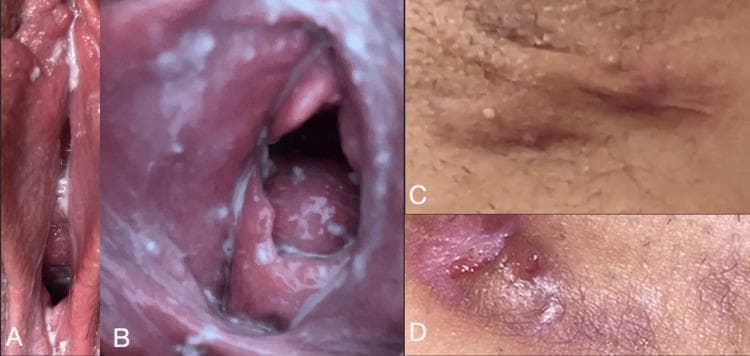 This composite of four clinical photographs illustrates gynecological and dermatological pathology. Images A and B are close-up clinical views of the vulva and vaginal mucosa demonstrating Candida vulvovaginitis. The images show significant mucosal erythema and a thick, white, adherent discharge with a curd-like or 'cottage cheese' texture localized within the vaginal folds and coating the vaginal walls. Images C and D display perianal or inguinal skin lesions consistent with hidradenitis suppurativa. Image C shows a linear, erythematous, and fibrotic-appearing scar or sinus tract. Image D demonstrates an inflammatory nodule with central suppuration and surrounding skin hyperpigmentation, characteristic of chronic follicular occlusion. This collection serves as an educational reference for distinguishing between fungal infections of the vaginal vault and chronic inflammatory skin diseases of the intertriginous regions, specifically highlighting the co-occurrence of vulvovaginitis and hidradenitis suppurativa.