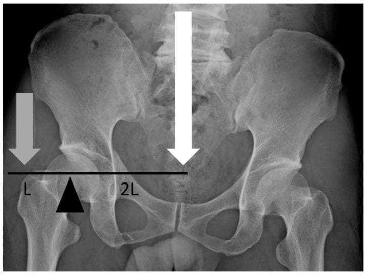 This diagnostic image is a coronal X-ray (radiograph) of the human pelvis and proximal femurs, overlayed with a biomechanical diagram to illustrate the physics of hip stability. The anatomical structures include the iliac wings, sacrum, pubic symphysis, and femoral heads articulating with the acetabula. The diagram represents the hip joint as a first-class lever system. A black triangle marks the center of the femoral head as the fulcrum. A large white arrow descending through the pelvic midline represents the force of body weight, while a gray arrow at the greater trochanter represents the counteracting force of the abductor muscles. A horizontal black line indicates the respective lever arms: 'L' denotes the short abductor lever arm and '2L' denotes the longer lever arm of body weight. The image is used to demonstrate how horizontal displacement in conditions like sacral perineural cysts (SPD) or pelvic fractures can extend the body weight lever arm, increasing the mechanical work and muscle force required to maintain pelvic balance.