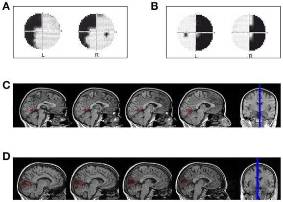 A multi-panel medical image illustrating the correlation between visual field defects and cortical lesions in two hemianopic patients. Panels A and B display Humphrey visual field perimetry results. Panel A shows a left superior quadrantanopia in patient LF, while Panel B shows a right homonymous hemianopia with foveal sparing in patient SL. Panels C and D provide diagnostic neuroimaging reconstructions via sagittal and coronal T1-weighted MRI slices. Panel C (Patient LF) highlights a focal red-labeled lesion in the anterior portion of the right calcarine fissure near the parieto-occipital fissure, consistent with the left-sided visual defect. Panel D (Patient SL) shows a larger red-labeled lesion in the left median para-sagittal occipital lobe involving the peri-calcarine cortex, corresponding to the right-sided hemianopia. The image serves as a clinical anatomical reference for mapping primary visual cortex (V1) damage to specific patterns of post-chiasmatic vision loss, such as quadrantanopia and hemianopia.