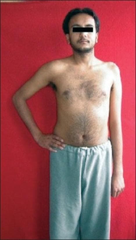 A clinical photograph of a male patient demonstrating the physical presentation of a left-sided upper brachial plexus palsy (Erb-Duchenne palsy), involving the C5 and C6 nerve roots. The image shows significant postural asymmetry between the upper limbs. The affected left arm exhibits classic clinical signs, including adduction at the shoulder and internal rotation of the humerus. There is visible muscle atrophy and a loss of rounded contour in the left deltoid and shoulder girdle compared to the healthy right side. Additionally, the left shoulder is positioned lower than the right. The patient's right arm displays a normal neutral position and muscle bulk. This visual serves as a primary clinical example of peripheral nerve injury manifestations, specifically highlighting the 'waiter's tip' position resulting from paralysis of the abductors and external rotators of the shoulder.