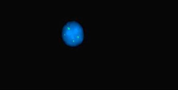 This diagnostic image demonstrates a fluorescence in situ hybridization (FISH) analysis of a human cell nucleus. The interphase nucleus is visualized with a blue counterstain, likely DAPI, highlighting the chromatin within the nuclear envelope. Inside the nucleus, four distinct bright green punctate signals are visible, representing fluorescently labeled probes targeting the 1p subtelomere region. The spatial arrangement shows a cluster of three signals in close proximity, with a fourth signal located separately within the nuclear territory. Clinically, the presence of four signals instead of the typical two indicates an abnormal copy number, such as tetrasomy or gain of the 1p chromosomal region, which is a significant finding in cytogenetics for diagnosing certain hematologic malignancies or solid tumors. This image is used to teach concepts of clinical genetics, chromosomal abnormalities, and molecular pathology techniques.