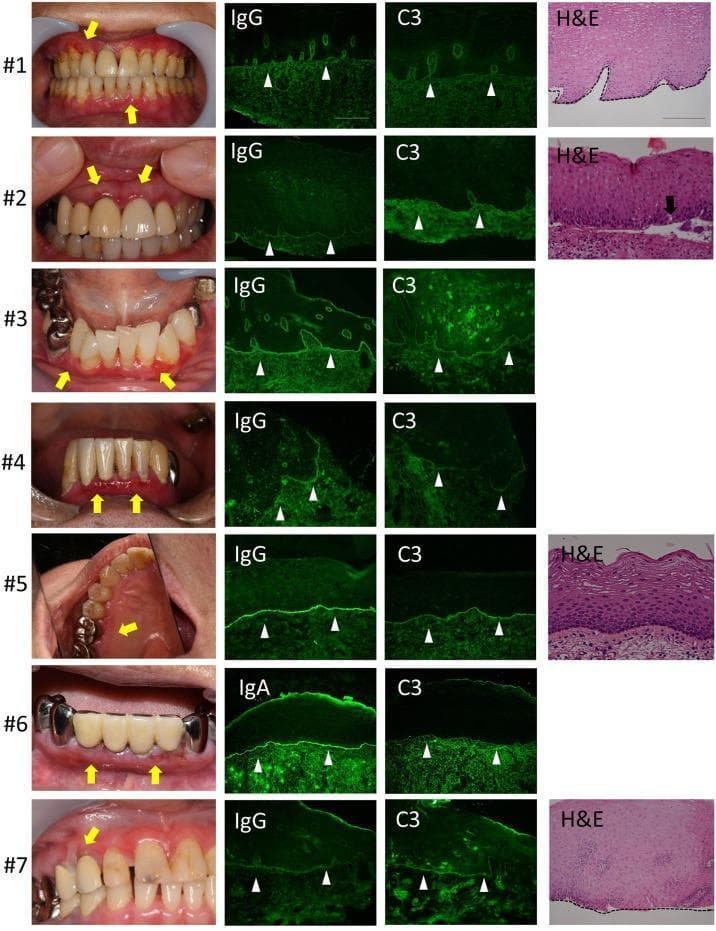 This composite educational graphic displays clinical, histological, and immunofluorescence findings from seven cases (labeled #1-#7) of mucous membrane pemphigoid presenting with oral manifestations. Column 1 features clinical photographs of the oral cavity, highlighting desquamative gingivitis and erythematous lesions (yellow arrows) involving the marginal and attached gingiva. Columns 2 and 3 present direct immunofluorescence (DIF) micrographs of buccal mucosa biopsies, demonstrating characteristic linear deposition of IgG (or IgA in case #6) and C3 (white arrowheads) along the basement membrane zone (BMZ). Column 4 provides histopathological images (H&E stain), showing subepithelial junctional separation at the BMZ (black arrow in case #2) and extensive tissue destruction in more severe cases. This visualization illustrates the diagnostic triad for autoimmune bullous diseases: clinical presentation of chronic gingival inflammation, histological evidence of subepithelial clefting, and the definitive DIF pattern of linear immunoreactant deposition at the dermal-epidermal junction. The content is suitable for dermatology, pathology, and dentistry education regarding immunobullous disorders.