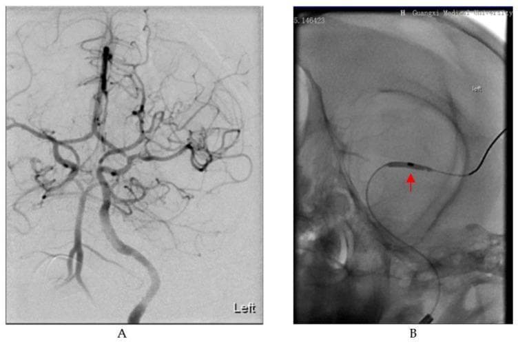 Digital Subtraction Angiography (DSA) of cerebral vasculature demonstrating endovascular stroke modeling. Figure A shows a baseline angiogram illustrating normal cerebral vascular anatomy, specifically the circle of Willis and its branching territories. The vessels appear as curvilinear, branching structures with smooth contours and uniform contrast opacification. Figure B captures an interventional procedure where a microcatheter and microguide wire are used to deploy a balloon. A red arrow identifies the inflated balloon catheter positioned within the M1 segment of the Middle Cerebral Artery (MCA). The balloon is visible as a radio-opaque, elongated distension causing temporary focal occlusion of the vessel to mimic an ischemic stroke event. This imaging serves as a demonstration of procedural neuro-intervention, focusing on the Middle Cerebral Artery (MCA) anatomy and the application of balloon-occlusion techniques for clinical or experimental modeling of ischemic cerebrovascular disease.