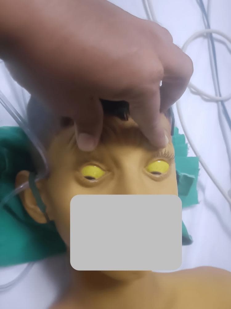 This clinical photograph displays a pediatric patient demonstrating severe systemic jaundice. The primary diagnostic feature is profound scleral icterus, characterized by a bright yellow discoloration of the entire visible sclera in both eyes. The upper eyelids are manually elevated to fully reveal the extent of the icterus. Additionally, the patient's facial skin, forehead, and upper chest exhibit a marked yellowish hue (jaundice), consistent with hyperbilirubinemia. The patient appears to be in a clinical setting, as evidenced by medical tubing and linens visible in the background. This image is an educational example of the physical manifestations of liver dysfunction or hemolytic processes, such as hepatitis, Wilsonian crisis, or acute toxicity, which can lead to significant accumulation of bilirubin in mucosal surfaces and skin.