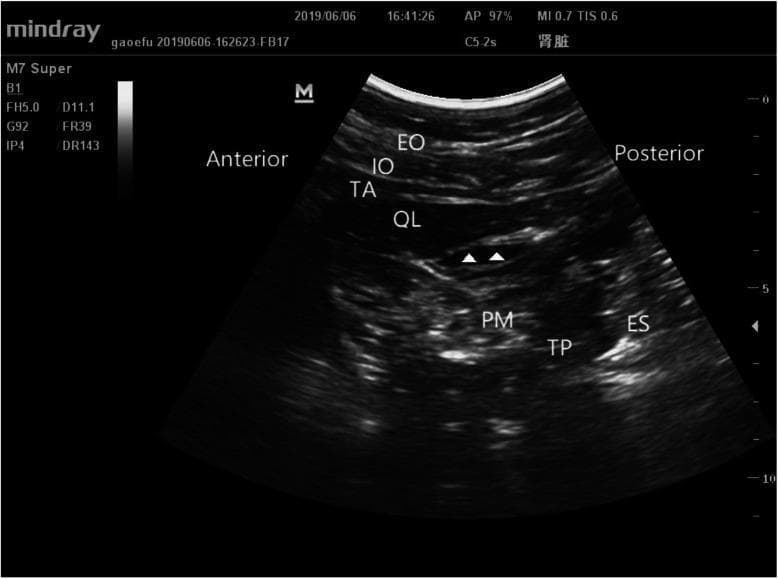 This diagnostic ultrasound image demonstrates the 'Shamrock sign' anatomy used for a transmuscular quadratus lumborum (TQL) block. The sonogram shows a cross-sectional view of the posterior abdominal wall with clearly labeled anatomical structures. From anterior to posterior (left to right), the external oblique (EO), internal oblique (IO), and transversus abdominis (TA) muscles are visible as distinct superficial layers. Deep to these, the quadratus lumborum (QL) muscle is positioned adjacent to the psoas major (PM) muscle. The transverse process (TP) of the lumbar vertebra and the erector spinae (ES) muscle are situated posteriorly. White arrowheads point to a hypoechoic region between the QL and PM muscles, representing the interfascial plane where local anesthetic injectate spreads during the procedure. The image illustrates the 'Shamrock' configuration formed by the QL, PM, and ES muscles surrounding the transverse process, providing a critical landmark for anesthesiologists to perform regional anesthesia for postoperative pain management.