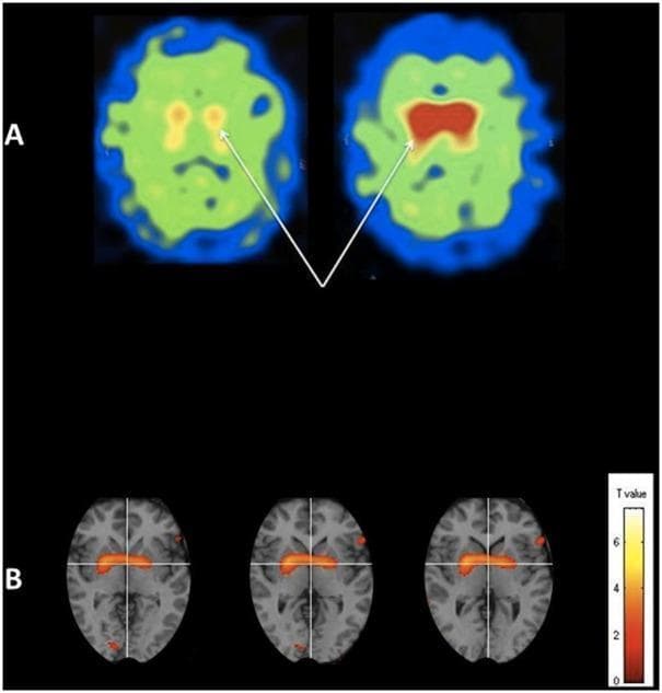 This composite diagnostic image illustrates the longitudinal effects of N-acetylcysteine (NAC) on dopamine transporter (DaT) availability in a Parkinson's disease patient. Section A displays two axial DaTscan (SPECT) images: 'pre-NAC' (left) and 'post-NAC' (right). The color-coded intensity maps show a transition from yellow/green to deep red in the striatum (caudate and putamen), indicated by arrows, signifying a substantial increase in dopamine transporter binding following treatment. Section B presents statistical parametric mapping (SPM8) results from a group-level paired t-test. Significant clusters (p < 0.05) are overlaid on axial T1-weighted MRI templates across three slices. These areas of significantly greater binding post-treatment are localized to the bilateral basal ganglia and are rendered in an orange-to-red color scale corresponding to T-values (0 to 6+). The visualization demonstrates both individual qualitative improvement in dopaminergic function and collective statistical significance in regional tracer uptake, relevant to clinical research in neurodegenerative disease management.