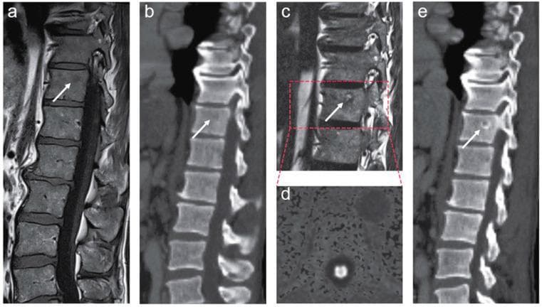 This composite of clinical diagnostic images illustrates the evolution and treatment response of a solitary thoracic spine bone marrow metastasis in a patient with metastatic prostate cancer. The panel is divided into pretreatment (a, b) and post-treatment (c-e) phases. Figures (a) and (b) show the initial focal lesion in a mid-thoracic vertebral body on sagittal MRI and CT, appearing as a subtle area of altered signal and density (white arrows). Following androgen deprivation therapy, figure (c) provides a sagittal T2-weighted fat-only Dixon MRI sequence showing a hyperintense signal within the lesion, indicating increased fat content—a typical sign of treatment response in bone marrow. Figure (d) presents a diffusion-weighted imaging (DWI) view with no evidence of restricted diffusion, suggesting a lack of active tumor cellularity. Finally, figure (e) shows a follow-up sagittal CT scan demonstrating perilesional sclerosis (increased bone density) surrounding the original site, further confirming local stabilization and treatment effect. This series serves as an educational example of multimodality imaging (MRI and CT) used to monitor oncological response in spinal metastases.