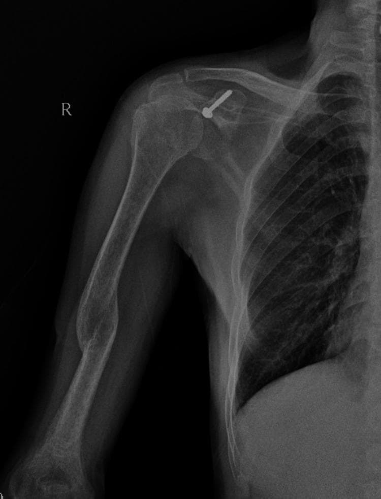 Anterior-posterior (AP) X-ray of the right shoulder and proximal humerus showing postoperative changes following a Latarjet procedure. The glenohumeral joint is well-reduced with anatomic alignment of the humeral head and glenoid fossa. A single metallic cannulated screw with a washer is visible, fixating the coracoid process graft to the anteroinferior glenoid rim to address anterior shoulder instability. The clavicle and acromioclavicular joint appear intact. Along the mid-diaphysis of the humerus, there is a localized area of cortical thickening and increased bone density, possibly representing a healed fracture or chronic stress response. The adjacent rib cage and apical lung field are unremarkable. This image demonstrates the surgical management of chronic anterior shoulder dislocation through coracoid transfer.