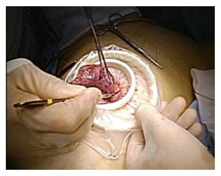This clinical photograph captures a surgical scene during a Laparo-Endoscopic Single-Site (LESS) procedure, specifically illustrating the extracorporeal manual morcellation of a uterine myoma. The surgical field features an Alexis wound retractor positioned within an umbilical incision, providing stable access and protection of the wound edges. Inside the retractor, an Endocatch II retriever bag contains the excised tissue, which is being manually morcellated using a number 11 surgical scalpel blade held by a gloved hand. The tissue mass appears solid with irregular, reddish-brown surfaces, consistent with a necrotized subserosal myoma. Additional instrumentation, including surgical forceps and scissors, is visible in the periphery. This technique demonstrates a protective method for tissue extraction designed to prevent intraperitoneal dissemination and port-site seeding of potentially malignant or fragmented tissue. The educational focus is on gynecological surgical techniques for minimally invasive tumor retrieval and safety protocols for manual morcellation.