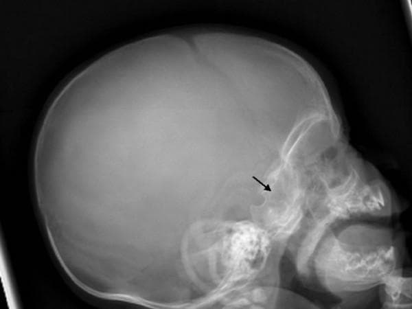 This diagnostic image is a lateral radiograph of a human skull, demonstrating significant skeletal abnormalities. The primary finding is diffuse hyperostosis of the calvaria, characterized by a marked thickening of the cranial vault and increased radiodensity, resulting in a sclerotic appearance. A black arrow specifically points to the skull base, highlighting localized sclerosis and increased bone density in the sphenoid and temporal regions. The normal trabecular pattern and clear differentiation of the cortical margins are obscured by the pathological bone deposition. Additionally, there is evidence of mandibular enlargement and facial bone thickening. These features are educationally significant for identifying systemic bone disorders, such as sclerosing bone dysplasias or metabolic bone diseases. The image is an essential resource for medical students and residents studying radiology and musculoskeletal pathology.