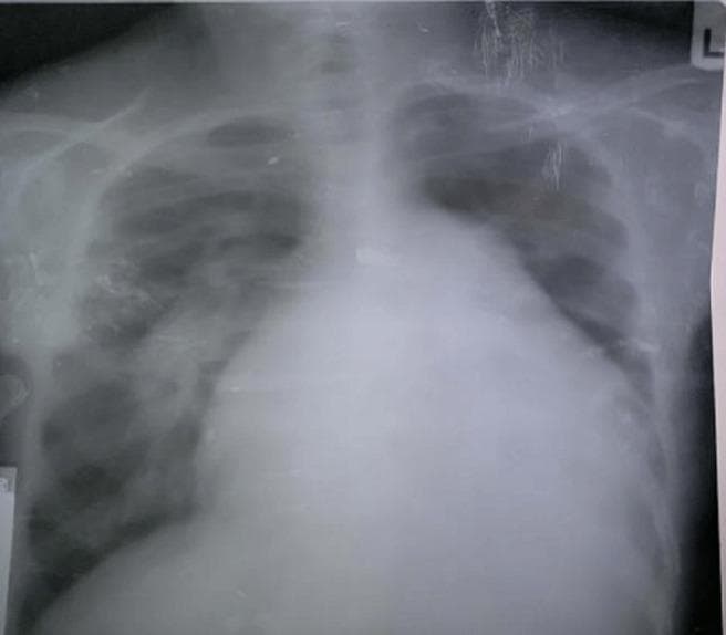 This diagnostic image is a posteroanterior (PA) view chest X-ray demonstrating significant cardiothoracic abnormalities. The most prominent feature is massive cardiomegaly, with a cardiothoracic ratio (CTR) estimated at 0.8, indicating the cardiac silhouette occupies 80% of the thoracic width. A notable bulge in the pulmonary conus is visible along the left heart border, suggestive of pulmonary hypertension or pulmonary artery dilation. The lung fields exhibit pulmonary plethora, characterized by increased vascular markings and congestion extending to the peripheral zones, typical of a left-to-right shunt (such as an atrial septal defect). The combination of these findings—cardiomegaly, a prominent pulmonary segment, and plethoric lung fields—is clinically significant for chronic volume overload and increased pulmonary blood flow, frequently seen in congenital heart disease with Eisenmenger physiology or advanced valvular disease. The image serves as an educational example of cardiac remodeling and pulmonary vascular redistribution in the context of high-flow cardiac shunts.