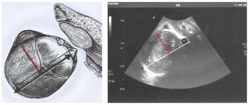 This composite educational graphic illustrates the ultrasonographic assessment of fetal head asynclitism during labor. The left panel shows an anatomical diagram of the fetal skull in a right occiput position, highlighting the sagittal suture and parietal bones relative to the maternal pelvis. The right panel displays a corresponding longitudinal translabial ultrasound image. A white line marks the midline (M) and the hyperechogenic cerebral falx between the hemispheres (indicated by white arrows). The pubic symphysis (PS) and a caput succedaneum (CS) on the left parietal bone are labeled. A red line represents the 'Asynclitism Degree' (AD), measured as the perpendicular distance from the anatomical midline to the sagittal suture. A black circle identifies the 'anterior squint sign,' a sonographic marker of anterior asynclitism where the orbits are misaligned relative to the ultrasound beam. This tool is critical in obstetrics for diagnosing fetal malposition and predicting the likelihood of intrapartum cesarean delivery (ICD) versus successful vaginal birth.