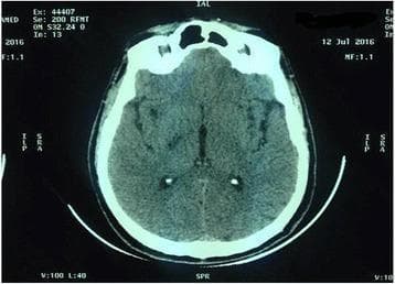 This diagnostic image is an axial non-contrast computed tomography (CT) scan of the brain. The scan displays the anatomy at the level of the basal ganglia and internal capsules. A focal area of subtle hypodensity is observed in the region of the right internal capsule, consistent with an acute ischemic stroke. The surrounding cortical gray matter and white matter differentiation are largely preserved, though there is a faint loss of definition in the affected territory. The ventricular system, including the third ventricle and the posterior horns of the lateral ventricles, appears normal in size and position with no evidence of midline shift or mass effect. The calvarium and surrounding scalp soft tissues are intact, and the visualized paranasal sinuses show normal aeration. This image serves as a clinical example of an early-stage lacunar or small territory infarct in a patient presenting with neurological deficits, illustrating the importance of CT in identifying parenchymal density changes in the acute stroke setting.