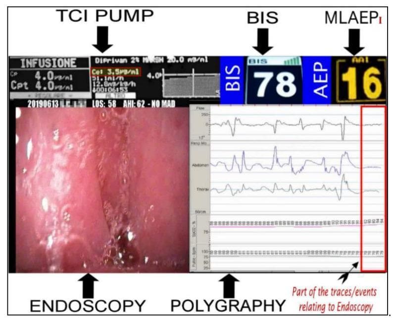 This composite educational image illustrates a 5-Video stream Experimental system (5VsEs) used during Drug-Induced Sleep Endoscopy (DISE). The display integrates five critical monitoring streams: a Target-Controlled Infusion (TCI) pump interface, depth of anesthesia indices, real-time endoscopy, and polygraphy. The TCI pump section displays Propofol administration data, including a plasma concentration (Cp) and target plasma concentration (Cpt) of 4.0 µg/ml, and a predicted effect-site concentration (Cet) of 3.5 µg/ml. Depth of anesthesia is quantified by the Bispectral Index (BIS), shown as 78, and the Middle Latency Auditory Evoked Potential index (MLAEPi/AAI), shown as 16. The lower left panel provides a live endoscopic view of the upper airway, while the lower right panel presents polygraphic waveforms (including flow, respiratory effort, and SpO2). A red rectangle highlights a period of apnea in the polygraphy trace, correlating the pharmacological sedation level with clinical airway obstruction. This setup is used to assess anesthetic pharmacodynamics and differentiate between obstructive and central sleep apnea during surgical evaluation.