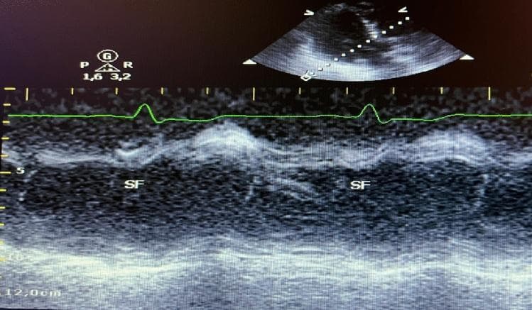 This diagnostic image displays a cardiac ultrasound featuring a dual-mode display: a parasternal long-axis view in 2D echocardiography (top) and a corresponding M-mode tracing (bottom). The M-mode captures the time-motion relationship of the interventricular septum and left ventricular walls. A green electrocardiogram (ECG) lead is superimposed over the M-mode to provide temporal synchronization with the cardiac cycle. The image specifically illustrates 'Septal Flash' (SF), marked with labels. This pathology is characterized by a rapid, pre-systolic inward motion of the interventricular septum, occurring immediately after the QRS complex on the ECG. This visual finding is a classic indicator of mechanical dyssynchrony, often associated with left bundle branch block (LBBB). The vertical axis indicates depth (up to 12.0 cm), while the horizontal axis demonstrates the progression through multiple cardiac cycles. This educational material is used to demonstrate the diagnostic utility of M-mode in identifying subtle wall motion abnormalities required for assessing candidates for Cardiac Resynchronization Therapy (CRT).