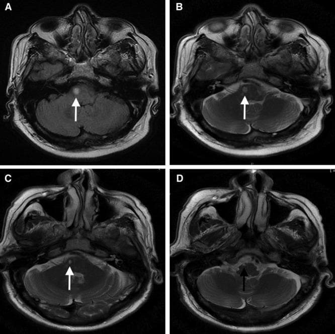A comparison of axial brain MRI scans (FLAIR and T2-weighted sequences) illustrating the evolution of a lacunar infarct and subsequent white matter degeneration. Panels A and B show baseline imaging 11 days post-stroke, identifying a symptomatic hyperintense lacunar infarct in the right pons (white arrow). Panel C displays a follow-up T2-weighted image at one year, showing the lesion has transitioned into a cavitated lacunar stroke. Panel D, a more inferior axial slice from the follow-up study, demonstrates a distinct white matter hyperintensity (WMH) track (black arrow). This track appears as an elongated, bright signal following the descending white matter pathway proximal to the original infarct, indicative of Wallerian-like degeneration. This diagnostic series highlights the long-term structural changes in small vessel disease, specifically distinguishing between the primary cavitated lesion and secondary white matter tracks in the brainstem. It serves as an educational resource for neuroradiology and neurology trainees regarding stroke progression and neurodegenerative sequelae.
