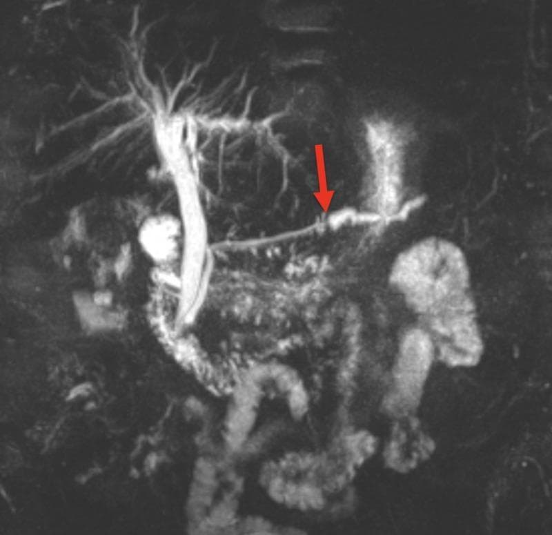 This coronal Magnetic Resonance Cholangiopancreatography (MRCP) image displays the biliary tree and pancreatic duct. The biliary system is visualized as a hyperintense, tree-like branching network in the upper quadrant, featuring the intrahepatic ducts and a prominent common bile duct. The primary focus is the main pancreatic duct, which exhibits significant ductal dilation in its distal portion. A red arrow indicates a point of abrupt transition where the duct diameter suddenly narrows, transitioning from the dilated distal segment to a more constricted proximal segment. This visual finding is characteristic of an obstructive pathology, such as a large pancreatic ductal stone or calculus located within the body of the pancreas. The image provides a clear example of how MRCP can identify obstructive lesions and their secondary effects on ductal morphology in the hepatobiliary system.
