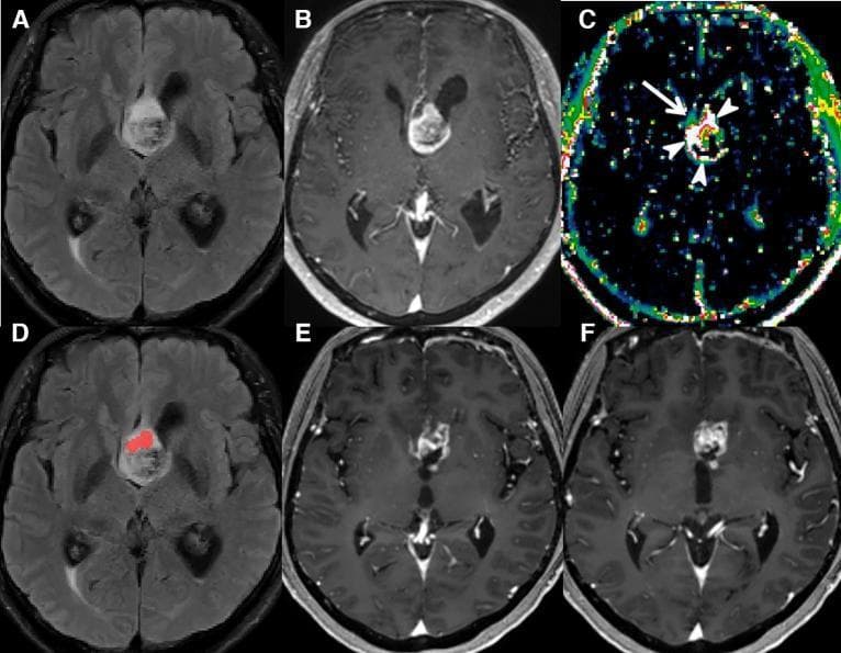 This composite of six axial brain MRI scans demonstrates a glioblastoma (GBM) and its progression over a 7-month interval. (A) T2-FLAIR image shows a hyperintense mass involving the septum pellucidum and corpus callosum with associated perilesional edema. (B) Contrast-enhanced T1-weighted (CE T1W) image displays the primary tumor's heterogeneous enhancement, signifying blood-brain barrier disruption. (C) A Ve map (extracellular extravascular volume fraction) highlights increased vascular permeability, with arrows pointing to focal areas of elevated Ve. (D) A predictive MRI model overlay identifies a high-risk region (red) for local recurrence within the non-enhancing T2 hyperintense zone. (E, F) Longitudinal follow-up CE T1W scans at 7 months confirm disease progression, evidenced by a new, measurable enhancing lesion at the genu of the corpus callosum. This sequence illustrates the clinical utility of combining conventional imaging with physiological MRI parameters (like Ve maps) and predictive modeling to anticipate sites of glioblastoma recurrence beyond the initial contrast-enhancing tumor margins.