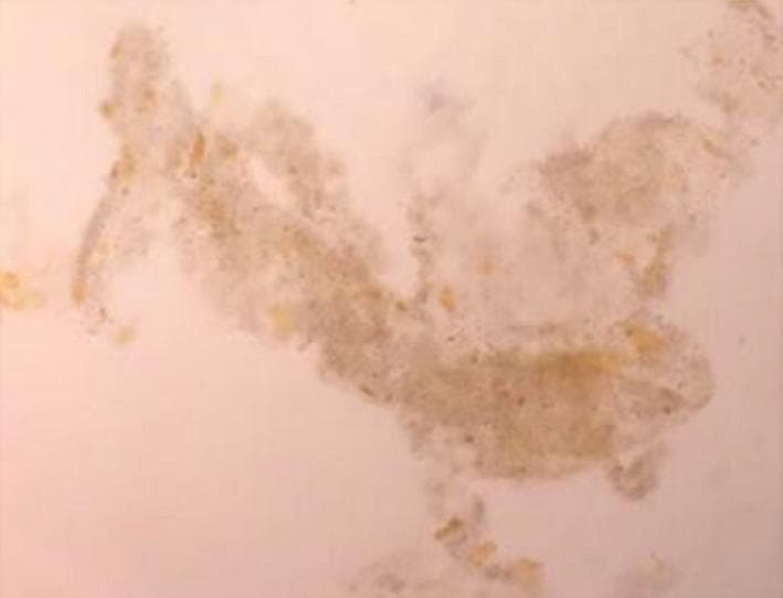 This diagnostic urine microscopy image at 400x magnification demonstrates multiple granular casts characteristic of acute tubular necrosis (ATN). The casts exhibit a classic 'muddy brown' coloration and granular texture, composed of degenerating tubular epithelial cells and debris. Notably, these casts also show distinct yellow to golden-brown pigmentation consistent with bile staining, a finding associated with severe hyperbilirubinemia or obstructive jaundice. The morphology includes elongated cylindrical structures alongside irregular and fragmented forms. The background of the slide is relatively clear and light, facilitating the high-contrast visualization of the darkly pigmented casts. This finding is clinically significant in the context of hepatorenal syndrome or bile acid nephropathy, where high levels of bilirubin can directly contribute to renal tubular injury and the formation of pigmented casts.