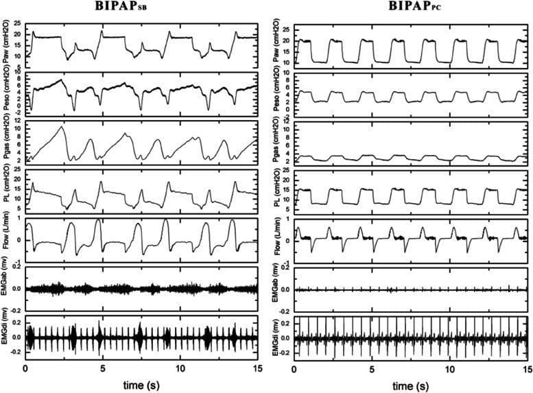 This physiological data visualization displays representative respiratory tracings comparing two mechanical ventilation modes: Biphasic Positive Airway Pressure with spontaneous breathing (BIPAPSB) and BIPAP with muscle paralysis (BIPAPPC). The x-axis tracks a 15-second duration. The vertical columns compare seven parameters: Airway pressure (Paw), Esophageal pressure (Peso), Intragastric pressure (Pgas), Transpulmonary pressure (PL), Airflow (Flow), Abdominal muscle surface electromyography (EMGab), and Diaphragmatic esophageal surface electromyography (EMGdi). In the BIPAPSB group, waveforms for Paw, Peso, and PL show irregular morphology and fluctuations indicative of spontaneous respiratory efforts, complemented by significant electrical activity bursts in the EMGdi tracing. In contrast, the BIPAPPC group exhibits highly regular, square-wave patterns in Paw and PL, consistent with passive, pressure-controlled ventilation. The EMGab and EMGdi tracings for the BIPAPPC group show near-total suppression of electrical activity, reflecting the state of muscle paralysis. This comparison illustrates the impact of patient effort on ventilatory pressures and muscle recruitment during mechanical ventilation.
