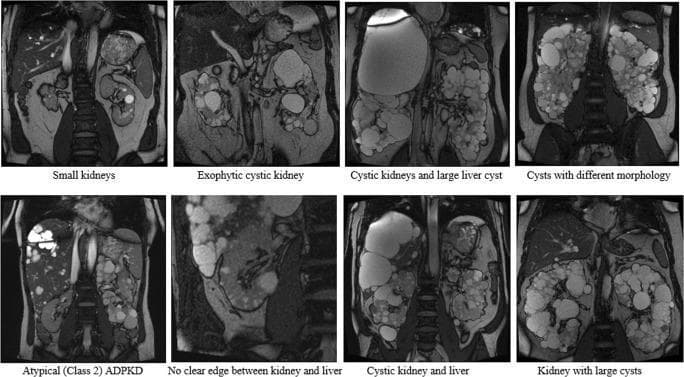 This composite diagnostic image features eight coronal MRI slices (T2-weighted) demonstrating the phenotypic spectrum of Autosomal Dominant Polycystic Kidney Disease (ADPKD). The images illustrate varied morphological presentations used for testing Total Kidney Volume (TKV) segmentation tools. Key clinical findings include progressive renal enlargement (nephromegaly) due to bilateral, multifocal cysts of varying sizes and distributions. Specific panels highlight ‘small kidneys’ with early-stage disease, ‘exophytic cystic kidneys’ where cysts protrude from the cortex, and kidneys with ‘large cysts’ causing significant architectural distortion. The series also depicts extrarenal manifestations, specifically polycystic liver disease (PLD), ranging from small focal lesions to large, hypointense hepatic cysts that obscure the renal-hepatic interface. One panel identifies Atypical (Class 2) ADPKD, characterized by asymmetric or focal cyst distribution. This collection serves as an educational resource for identifying Mayo Clinic Imaging Classification variations and understanding the challenges of automated renal segmentation in chronic kidney disease.
