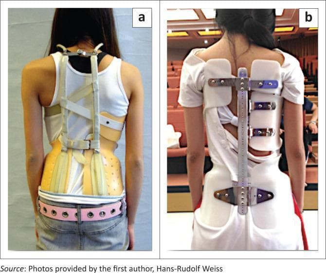 Two clinical photographs (a and b) show the posterior view of patients wearing orthopedic spinal braces for the treatment of scoliosis. Image (a) depicts a Milwaukee brace, a cervico-thoraco-lumbo-sacral orthosis (CTLSO). Visible components include a rigid, molded pelvic section, two posterior vertical metal bars, and a neck ring designed to provide longitudinal traction and lateral stability. Straps and pads are positioned along the torso to apply corrective forces to the spinal curvature. Image (b) shows a Lyon brace (ART brace), which is a rigid thoraco-lumbo-sacral orthosis (TLSO). It features a modular design with a central posterior metal upright, adjustable metal hinges, and molded plastic segments. This brace utilizes a multi-point pressure system for curve correction and is shown configured for a right thoracic curve. Both images illustrate historical and contemporary orthotic interventions used in pediatric and adolescent idiopathic scoliosis to prevent curve progression and manage trunk asymmetry.