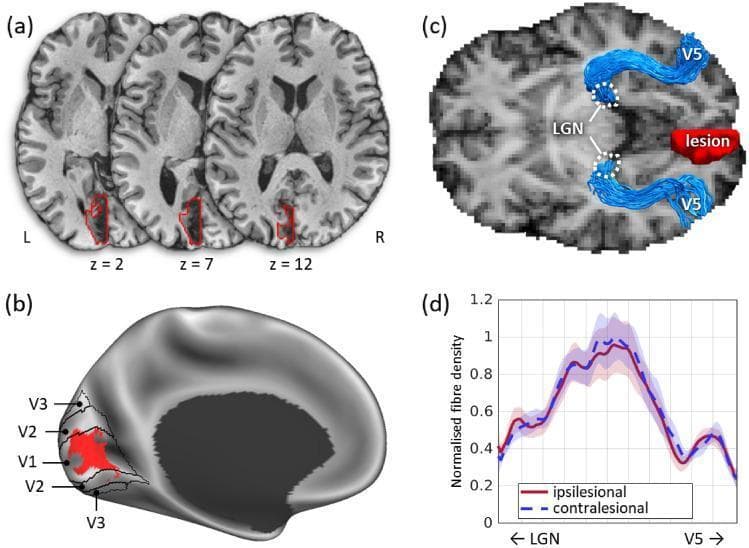 A multi-panel figure illustrating a circumscribed brain lesion and its impact on structural connectivity. (a) Sequential axial T1-weighted MRI slices (z = 2, 7, 12) show a lesion outlined in red, localized to the medial occipital lobe within the primary visual cortex (V1). (b) A 3D surface reconstruction of the medial cortex displays the lesion's extent relative to functional boundaries V1, V2, and V3, highlighting significant V1 involvement with partial sparing near the occipital pole. (c) Diffusion-based tractographic reconstruction visualizes the optic radiations (blue) connecting the lateral geniculate nucleus (LGN) to area V5 (hMT+). The red-contoured lesion is positioned medially, demonstrating that the lateral pathways to V5 remain structurally intact. (d) A line graph compares normalized fiber density along the LGN-V5 pathway between the ipsilesional (red) and contralesional (blue dashed) hemispheres. The overlapping profiles indicate no significant microstructural difference in fiber density between the damaged and healthy hemispheres, suggesting preserved subcortical-cortical connectivity for motion processing despite the V1 lesion.