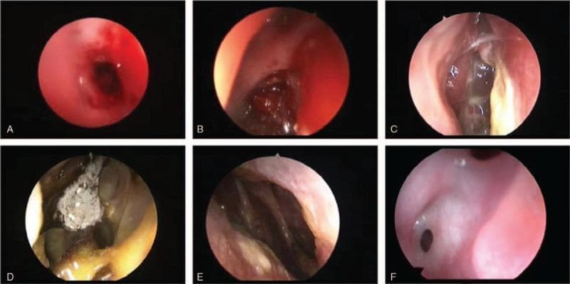 A composite clinical diagnostic image containing six nasal endoscopy frames (AβF) documenting postoperative complications following endonasal transsphenoidal surgery. (A) Active nasal hemorrhage characterized by bright red, fluid blood obscuring the field. (B) Evidence of previous hemorrhage with dark, solidified blood clots within the nasal passage. (C) Sphenoid sinusitis presenting with yellowish purulent discharge and polypoid mucosal changes. (D) Atrophic rhinitis featuring characteristic crusting and a greyish-white fungal ball/infection. (E) Nasal septum perforation showing a clear structural defect allowing visualization of the contralateral nasal cavity. (F) Right nasal synechia (adhesion) consisting of a fibrotic tissue bridge connecting the nasal septum to the lateral wall. This clinical photograph series serves as an educational reference for Otorhinolaryngology and Neurosurgery trainees to identify common and rare sequelae of endoscopic skull base procedures, emphasizing tissue healing, infection, and structural integrity of the sinonasal mucosa.