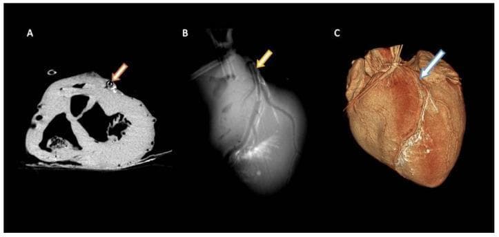 This composite diagnostic image displays three different radiological views of a porcine heart model used for cardiovascular research. Panel A (Axial view) shows a transverse section of the ventricles with an artificial atherosclerotic plaque inserted into the Left Anterior Descending (LAD) artery, appearing as a dense, hyper-attenuated ring-like structure (indicated by an orange arrow). Small, contrasted circular structures representing cardiac lymphatic vessels are visible adjacent to the LAD. Panel B (Maximum Intensity Projection - MIP) offers a two-dimensional projection where the LAD and its branching lymphatic network appear as thin, high-contrast linear structures (yellow arrow). Panel C (Volume-Rendering Technique - VRT) provides a three-dimensional anatomical reconstruction of the heart surface, highlighting the spatial distribution and network-like arrangement of the cardiac lymphatics (light blue arrow) as they track along the epicardial surface near the LAD. The image demonstrates the capabilities of advanced CT imaging in visualizing coronary pathology and the associated lymphatic system for preclinical procedural modeling.