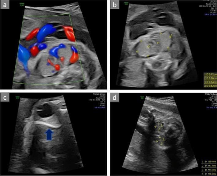A multi-panel fetal ultrasound series demonstrating the diagnosis and monitoring of a fetal goiter associated with hyperthyroidism. Panel (a) shows a transverse view of the fetal neck utilizing color Doppler, revealing marked hypervascularity (the 'thyroid inferno' sign) within an enlarged thyroid gland. Panel (b) illustrates transverse biometry of the fetal thyroid, with calipers measuring an enlarged gland (dimensions approximately 0.72 cm to 0.96 cm). Panel (c) shows a fetal orbital view with a blue arrowhead pointing to retro-orbital tissue enlargement, indicative of fetal exophthalmos. Panel (d) displays a follow-up transverse ultrasound at 26 weeks, showing calipers measuring a reduced thyroid size (8.9 mm to 9.6 mm) following maternal propylthiouracil (PTU) treatment. The series illustrates the clinical management of fetal Graves' disease, highlighting key diagnostic markers: fetal goiter, increased vascularity, and associated signs like exophthalmos, as well as the utility of serial biometry for assessing therapeutic response in utero.