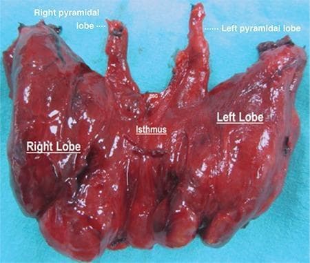 Anatomical specimen photograph of a human thyroid gland post-total thyroidectomy, set against a blue surgical background. The specimen is labeled to demonstrate a rare anatomical variation: bilateral pyramidal lobes. Centrally, the isthmus connects the voluminous right and left lateral lobes. Arising superiorly from the junction points between the isthmus and each lateral lobe are two distinct, elongated, conical structures identified as the right and left pyramidal lobes. The entire gland exhibits a reddish-brown, glistening parenchyma with a multinodular texture consistent with toxic multinodular goiter. The anatomical landmarks are labeled with white text: 'Right Lobe', 'Left Lobe', 'Isthmus', 'Right pyramidal lobe', and 'Left pyramidal lobe'. This clinical photograph is highly relevant for endocrine surgery and gross anatomy education, highlighting developmental remnants of the thyroglossal duct and the necessity of complete dissection during thyroidectomy to ensure total removal of all functional thyroid tissue.