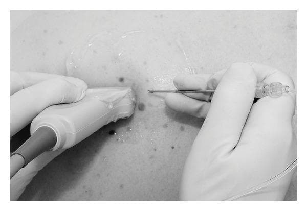 This procedural photograph demonstrates a thoracic paravertebral block technique under ultrasound guidance. A clinician, wearing white sterile medical gloves, uses a high-frequency linear ultrasound transducer covered with a protective sheath to visualize the underlying paraspinal anatomy. A generous amount of conductive ultrasound gel is applied to the skin of the thoracic region, which shows several benign-appearing nevi. A 16G Tuohy needle is being advanced using a craniocaudal in-plane technique, where the needle is oriented parallel to the long axis of the transducer beam to allow for continuous visualization of the needle shaft and tip. The needle features a clear plastic hub attached to extension tubing for local anesthetic delivery. This image illustrates the standard clinical setup for regional anesthesia, highlighting the spatial relationship between the transducer and the needle entry point to ensure precise localization within the paravertebral space.