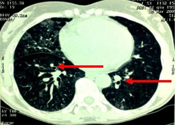 This diagnostic image is an axial slice from a Computed Tomography (CT) scan of the chest, displayed in a lung window. The primary finding is widespread cylindrical bronchiectasis, indicated by red arrows pointing to dilated, thick-walled bronchi. In cross-section, these dilated airways demonstrate the characteristic 'signet ring' sign, where the diameter of the bronchus is significantly larger than its accompanying pulmonary artery. The distribution of the bronchiectasis is bilateral and diffuse, involving multiple lobes. The background lung parenchyma exhibits heterogeneous areas of increased opacity and textural irregularity consistent with chronic inflammatory or post-infectious changes, though no acute pulmonary consolidation is visible. This imaging illustrates the typical morphological presentation of secondary bronchiectasis, often associated with chronic respiratory conditions or recurrent aspiration. The scan demonstrates the diagnostic utility of HRCT in evaluating airway dilation and bronchial wall thickening.