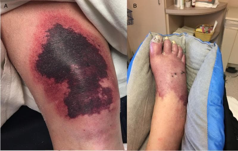 This clinical photograph consists of two panels illustrating severe cutaneous manifestations of warfarin-induced skin necrosis and heparin-induced thrombocytopenia (HIT) with secondary protein C deficiency. Panel A displays the right knee, featuring a large, irregularly shaped, well-demarcated purpuric plaque. The lesion exhibits central black eschar formation indicating tissue necrosis, surrounded by a violaceous, erythematous inflammatory border. Panel B shows the distal right foot and ankle, demonstrating diffuse, deep purplish-blue discoloration consistent with retiform purpura and impending gangrene. The foot exhibits significant edema, thickened and yellowed toenails (onychomycosis), and scattered petechiae or small necrotic foci. These visual findings are classic for a hypercoagulable state leading to microvascular thrombosis and subsequent skin infarction. The images serve as educational examples of critical dermatologic emergencies associated with anticoagulant complications and severe thrombotic disorders.