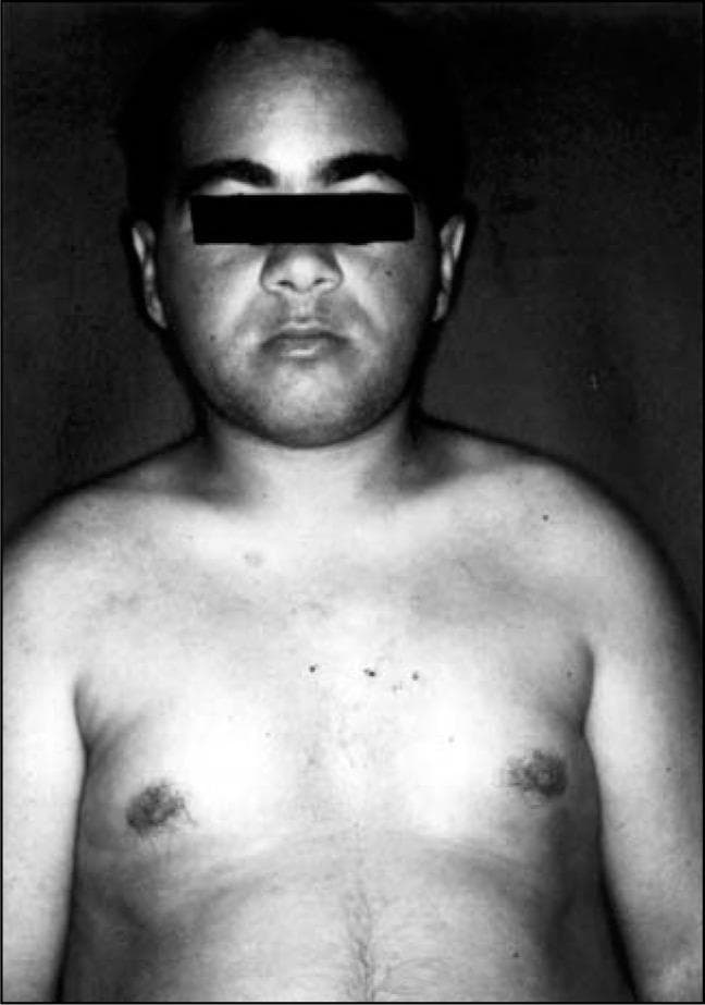 Clinical photograph (black and white) showing the frontal view of a young male patient's face, neck, and upper torso. The image demonstrates characteristic dysmorphic features including a round facies, broad forehead, and a short neck. The torso shows mild central adiposity and several small, scattered hyperpigmented skin lesions across the upper chest and shoulders. The skin appears otherwise smooth with no evidence of the previously reported erythematous scaly plaques, indicating clinical remission following treatment with calcium and vitamin D supplements. This visual presentation is consistent with the phenotype of Albright hereditary osteodystrophy (AHO), often associated with pseudohypoparathyroidism, where skin manifestations such as psoriasis-like lesions can occur due to hypocalcemia and resolve upon metabolic correction.