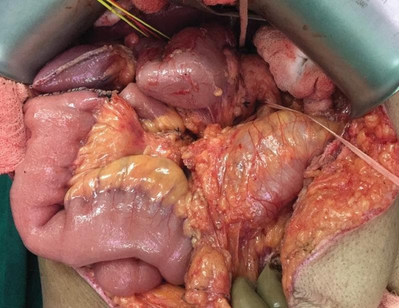 This clinical photograph is an intraoperative view of the abdominal cavity during a surgical procedure, demonstrating classic findings of intestinal nonrotation. The image shows the small bowel loops clumped primarily within the right upper quadrant of the abdomen, rather than following the standard peripheral distribution. Centrally and near the midline, the cecum and hepatic flexure are visible, indicating an arrest in the normal 270-degree counterclockwise rotation during embryological development. The duodenum appears vertically oriented, lacking its typical C-loop configuration, with the duodenojejunal flexure positioned to the right of the midline. Surgical retractors and laparotomy pads are visible at the periphery of the operative field, exposing the mesenteric attachments and the atypical positioning of the midgut structures. This visual provides high educational value for surgical anatomy, embryology, and the diagnosis of congenital malrotation in an adult clinical context.