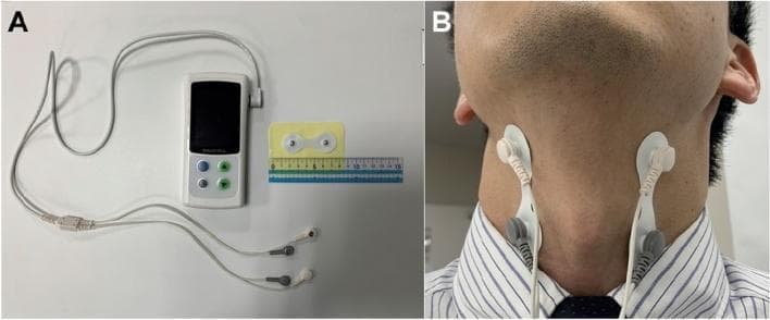 This composite clinical photograph illustrates a cervical percutaneous interferential current stimulation (IFC) device and its application for dysphagia or cough reflex therapy. Panel A shows the portable IFC unit, featuring a digital display and control buttons, connected via a bifurcated cable to four electrode connectors. A ruler is placed for scale alongside a pair of surface electrode pads. Panel B demonstrates the clinical application on a human subject. Two adhesive electrode pads are placed bilaterally on the anterior neck. The pads are positioned between the lower border of the mandibular angle and the anterior margin of the sternocleidomastoid muscle, targeting deep cervical structures. This setup is designed to deliver a 50 Hz interference current to facilitate swallowing-related muscle activation or sensory stimulation. The visual serves to guide clinicians on correct electrode placement and hardware configuration for neuromodulation in the context of neurogenic swallowing disorders, such as those seen in Parkinson's disease.
