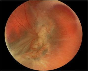 This color fundus photograph of a left eye demonstrates severe ocular pathology, characterized by total retinal detachment and advanced proliferative vitreoretinopathy (PVR). The retinal tissue exhibits a significant loss of normal transparency, appearing opaque, pale, and thickened with prominent corrugations and folds. The normal red-orange fundus reflex is obscured by this elevated, fibrotic tissue. Central and posterior regions show extensive tractional changes and epiretinal membrane contraction, which distort the normal vascular architecture and completely obscure the macula and foveal landmarks. Tortuous retinal vessels are visible on the surface of the detached retina, some showing signs of displacement. The overall clinical picture represents an end-stage manifestation of complex retinal disease, such as X-linked retinoschisis complicated by chronic rhegmatogenous retinal detachment and failed surgical repairs. This image serves as a clinical example of Grade C or D PVR where intraocular scarring has led to profound structural distortion and total detachment.