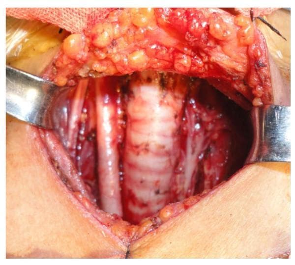This clinical photograph displays an intraoperative view of a total thyroidectomy combined with level III-IV and VI neck dissection. The surgical field is exposed using metal retractors, revealing central neck anatomy. Centrally, the trachea is clearly identified by its characteristic horizontal cartilaginous rings. The thyroid gland has been removed, providing visibility of the pretracheal and paratracheal regions. Lateral to the trachea, neurovascular structures are visible, including the carotid sheath contents. Evidence of surgical intervention includes cauterized tissue edges, small ligated vessels, and visible subcutaneous adipose tissue in the superior flap. The image demonstrates the surgical bed after completion of the thyroidectomy and lymph node dissection, emphasizing the clear identification of the trachea and the preservation of adjacent vital structures. This visual is representative of surgical oncology and endocrine surgery, specifically for the management of papillary thyroid microcarcinoma requiring central and lateral compartment neck dissection.