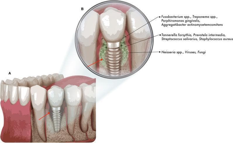 A medical anatomical diagram illustrating the pathophysiology of peri-implantitis and associated bone loss. Section A shows a cross-sectional view of the mandible with a dental implant integrated between natural teeth. A red arrow indicates localized alveolar bone resorption around the implant's threaded body. Section B provides a magnified view of the infectious process. It depicts the exposed implant surface following bone loss, which is heavily colonized by a complex microbial biofilm (represented in green). Labels identify specific pathogens involved in the biofilm community, including anaerobic bacteria such as Fusobacterium spp., Treponema spp., Porphyromonas gingivalis, Tannerella forsythia, and Aggregatibacter actinomycetemcomitans, as well as opportunistic fungi and viruses. The diagram highlights how progressive bone destruction provides an environment for bacterial colonization and the subsequent formation of a multi-species biofilm, which further exacerbates tissue inflammation and implant failure. This visual is designed for dental education, focusing on implantology and oral microbiology.